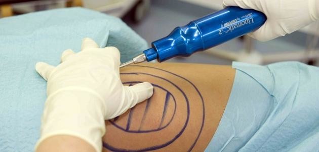 البراءة لطبيب متهم بـ”القتل أثناء عملية تجميل”