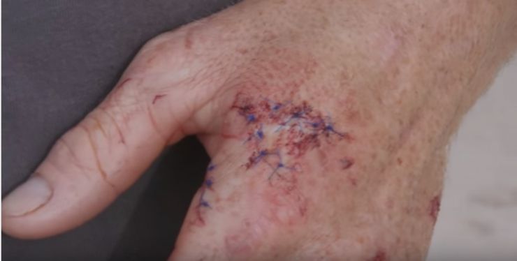 شاهد .. كيف انتقم شاب من قرش تسبب له 15 غرزة!
