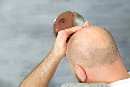علماء صينيون يخترعون لصاقة تعالج الصلع في أقل من شهر